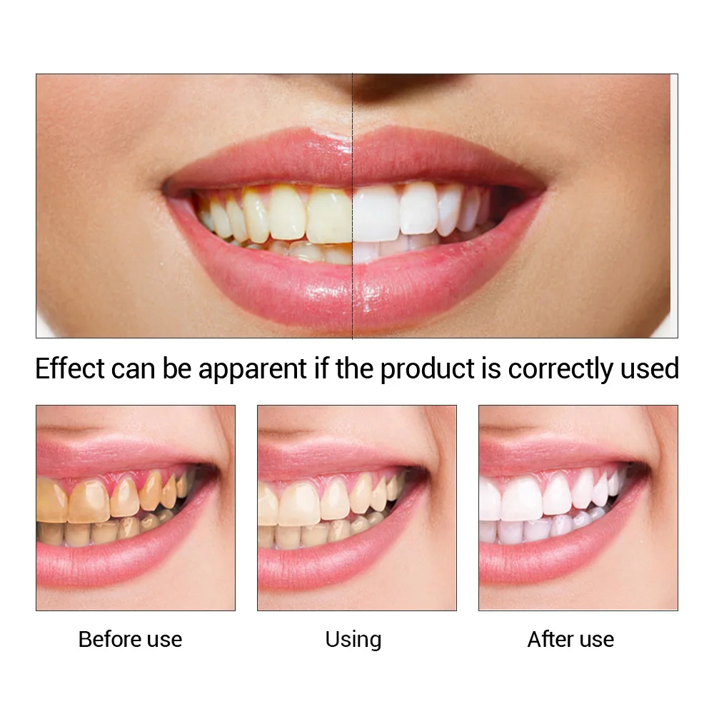 FTEENPLY Teeth Whitening Essen - Teeth Whitening App review and price