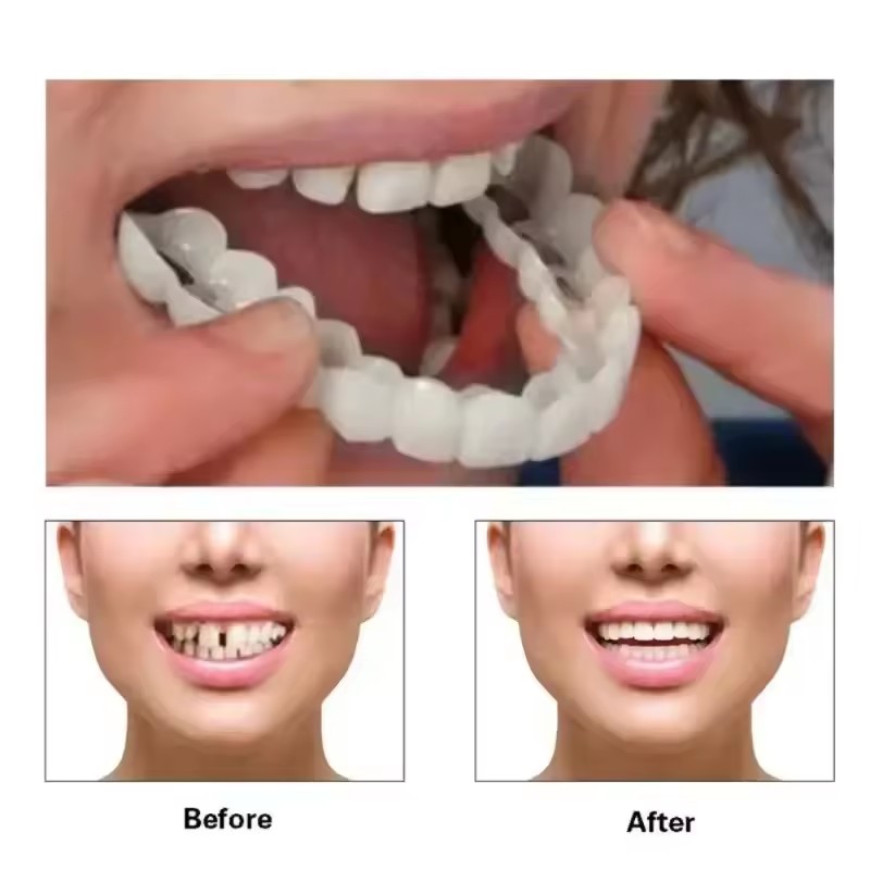 Teeth Veneers Whitening Dentur - Teeth Whitening Kit review and price