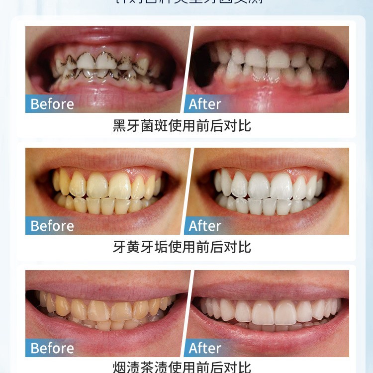 Japan Manual Tooth Stain Remov - Teeth Whitening Japan review and price